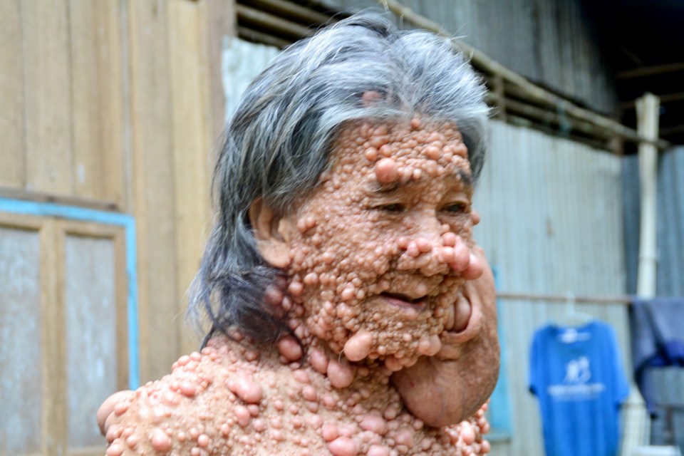  Shiti Charoenrattanaprapa has disfiguring bubble-like tumours covering his face and body because of neurofibromatosis