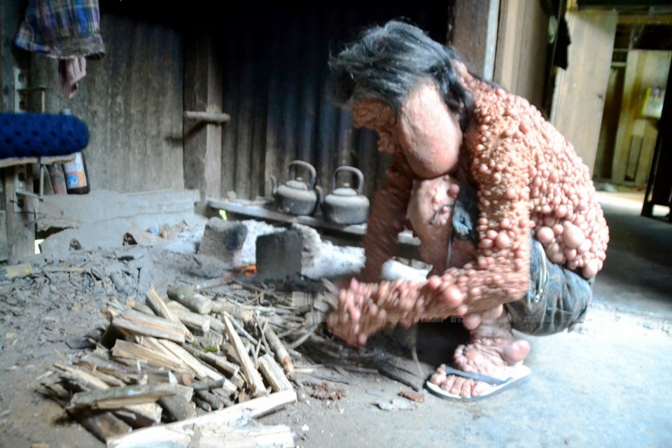  He was exiled from his community in Bangkok because of his appearance 45 years ago and now lives in a hut