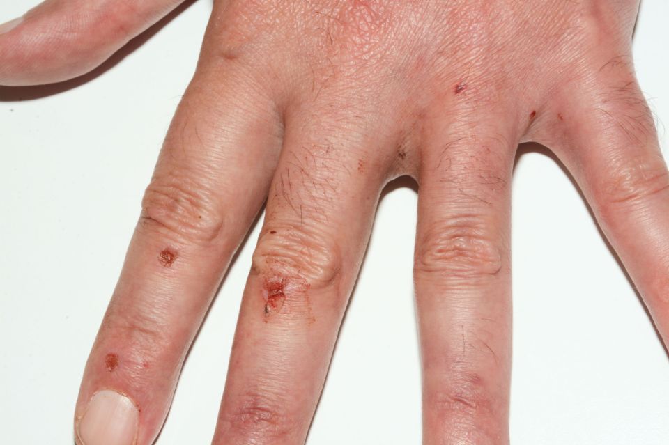  An injury to the hand of Thomas Mair which was shown to jury at the Old Bailey