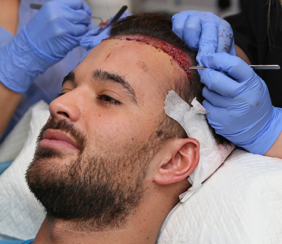  Towie star Mike Hassini has undergone a hair transplant to make sure his quiff stands the test of time