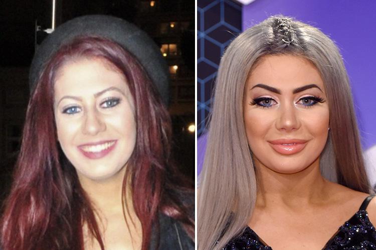  Since 2014 Chloe Ferry has had lip fillers, eyebrow-lift injections, veneers and Botox and revealed she wants a second nose job after being unhappy with the one she had in May