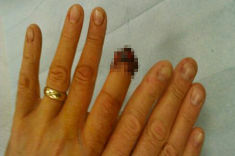  Doctors were unable to reattach the missing portion of Brian's finger