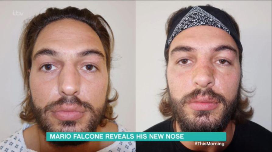  Mario Falcone had a bump removed from his nose in October after feeing self-conscious about a Twitter account dedicated to it had more followers that he did