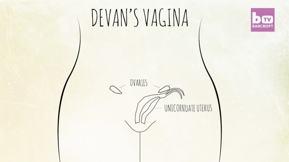  The diagram shows how Devan's reproductive system was not formed properly