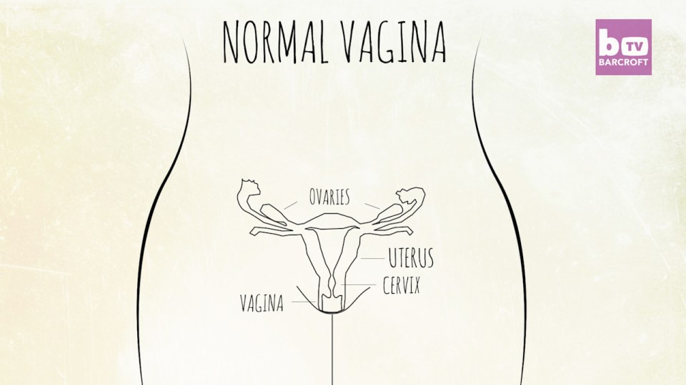  In contrast, this is a diagram of a normal, fully-formed female reproductive system