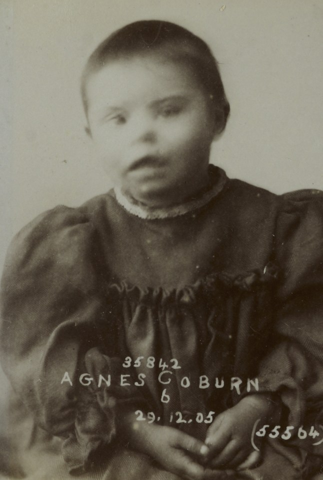  Agnes Coburn, six, had Down’s syndrome and suffered with severe conjunctivitis