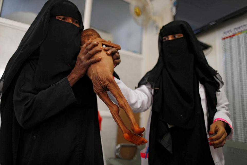  A severely-malnourished child is handed to medical staff