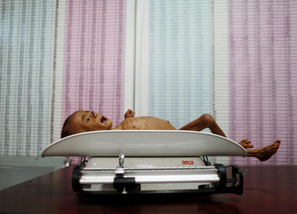  A malnourished boy lies on a scale at a hospital