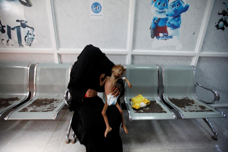  A woman holds her son at a malnutrition intensive care unit in the Red Sea port city of Houdeidah, Yemen