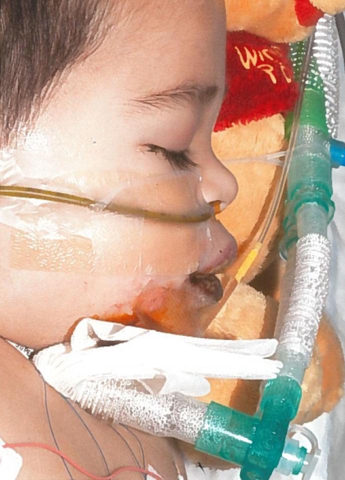  The six-year-old, who was two at the time, cannot speak and has to be fed through a tube