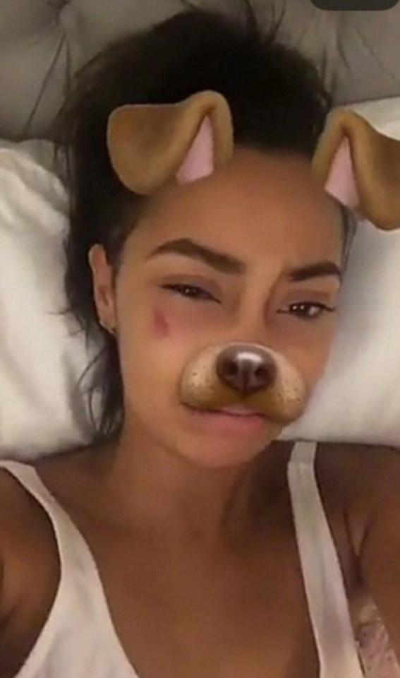  Leigh-Anne Pinnock shares pic on Snapchat showing her painful looking bruise