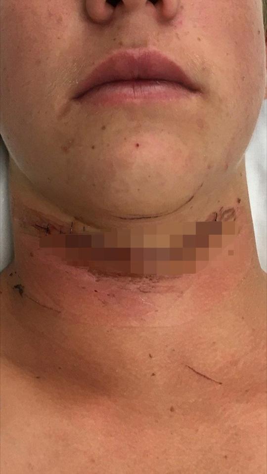  He needed stitches to the six-inch gash across his throat caused by the headphone wire