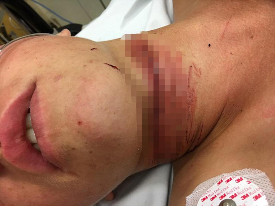  The cable snagged on a fence and sliced deep into his throat, narrowly missing his windpipe