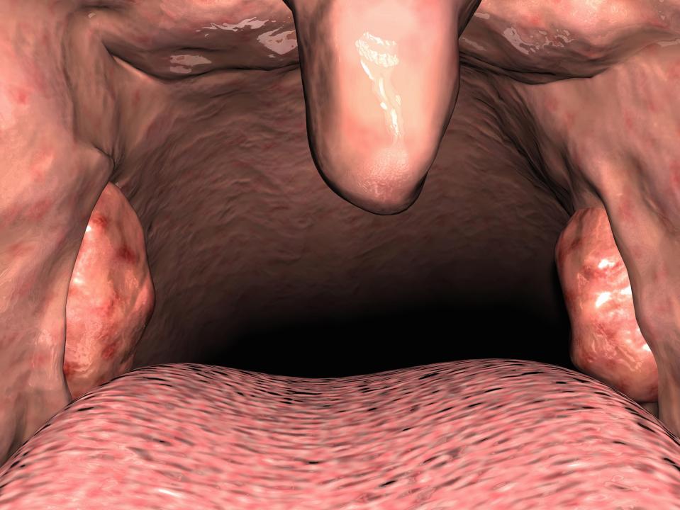  This is a medical illustration of the uvula and tonsils sitting in the oral cavity