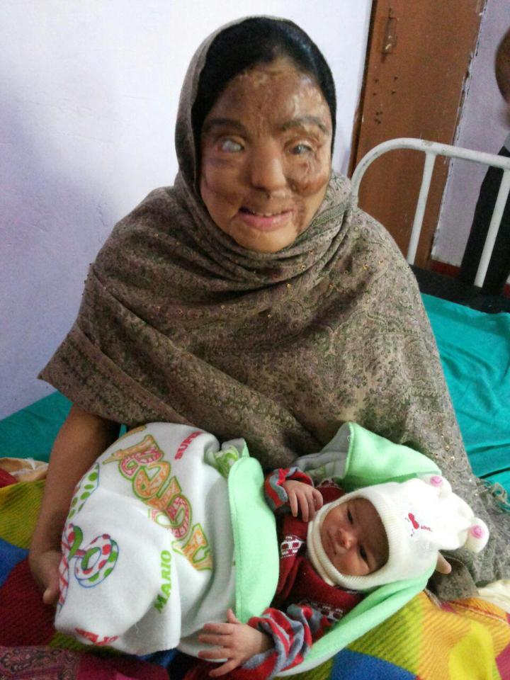  Sonali lost her eyesight and some of her hearing in the acid attack