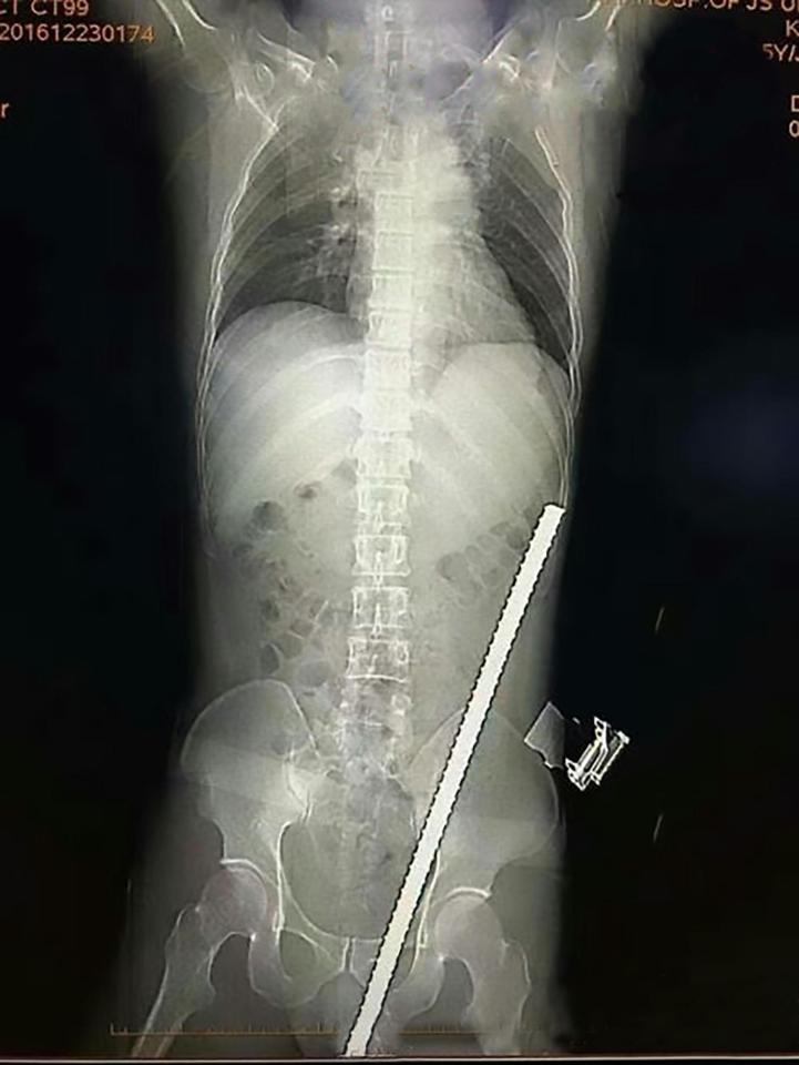  An X-ray showing the bar lodged inside the man's body