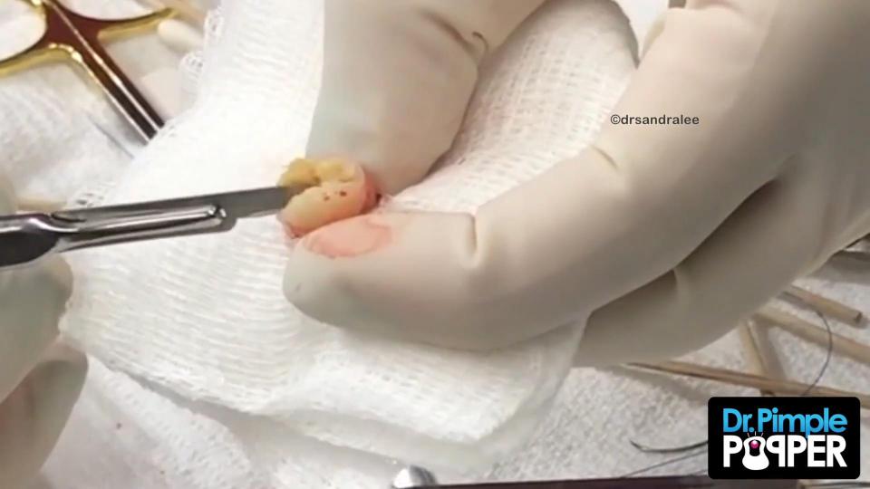  Dr Pimple Popper cut into the cyst revealing a lumpy puss encased in a thick wall of skin