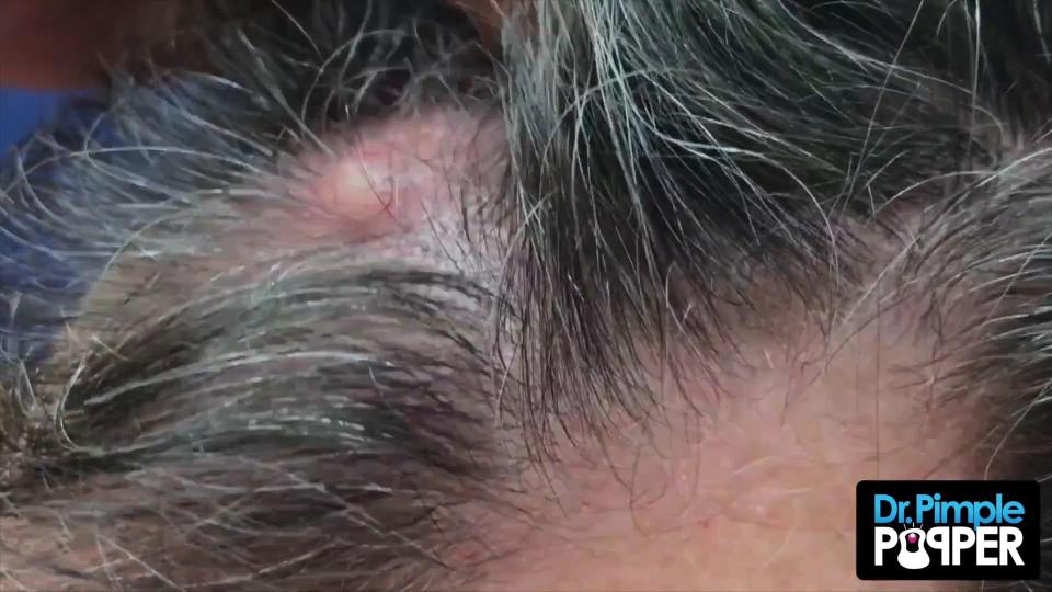  The cyst was on the man's head, hidden underneath his hair