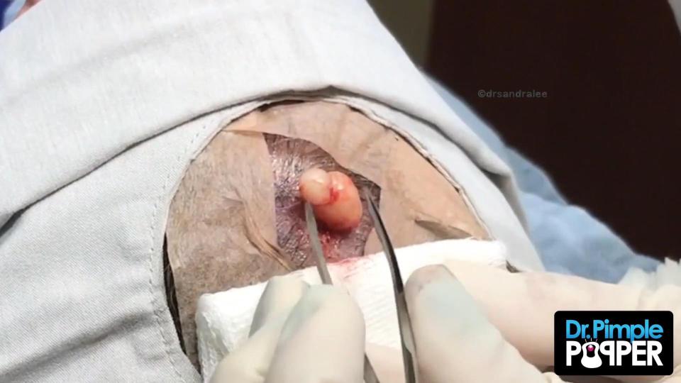  Quickly afterwards a second lump popped out creating a 'snowman' shaped cyst