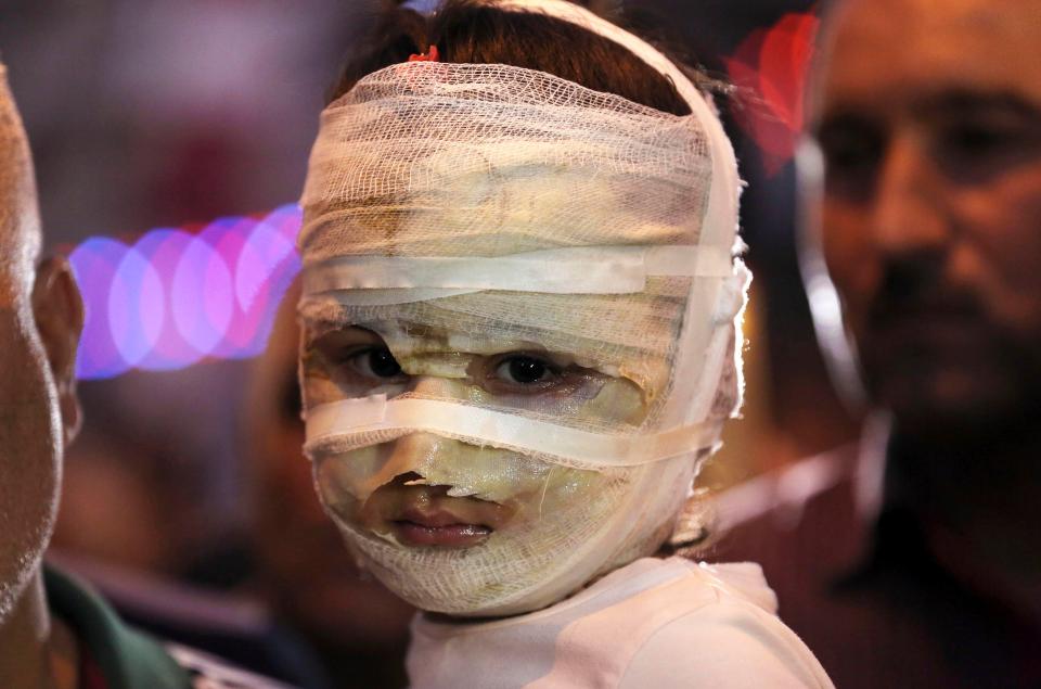  Asal Ahmed, 4, was badly burned during a suicide truck bomb attack in Karada, Iraq, during the Muslim holiday of Eid al-Fitr