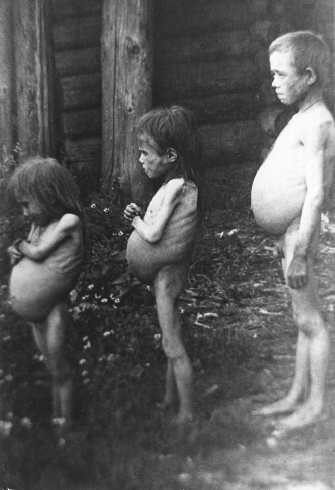  Three naked children pictured swelled stomachs