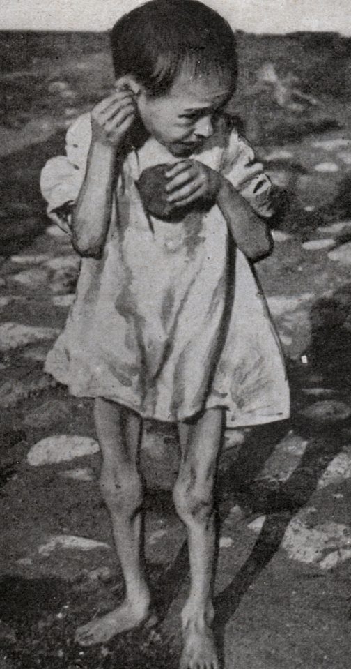  A child looks almost skeletal during the famine which claimed millions of lives