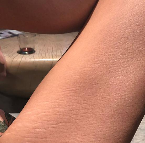  Chrissy Teigen also posted her stretch marks yesterday