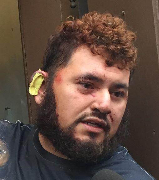  Marco Ortiz shows the part of his ear bitten off during the brawl over Donald Trump's immigration policies