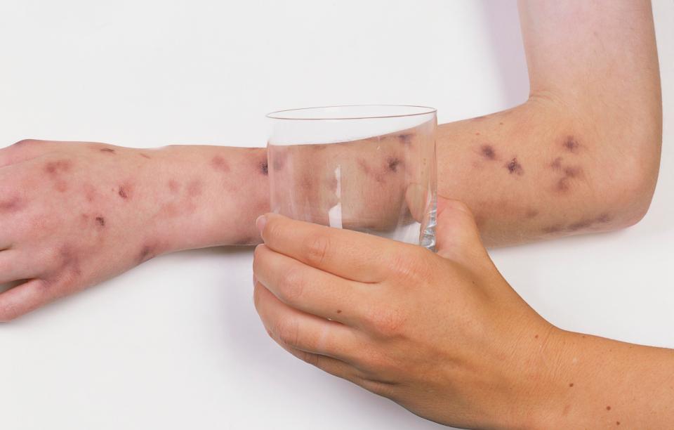  In cases of sepsis, the rash will not fade if you press a glass to it