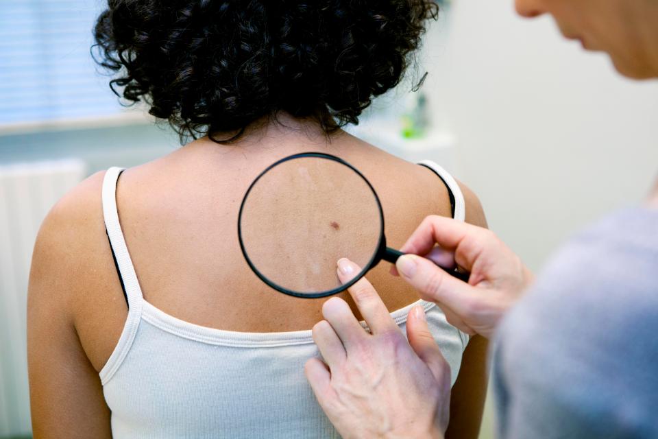  A new drug virtually stops the deadliest form of skin cancer in its tracks, experts have revealed