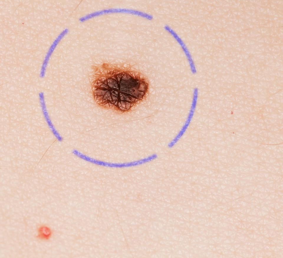  Melanoma is the most dangerous form of skin cancer, largely because it tends to spread to the brain and lungs