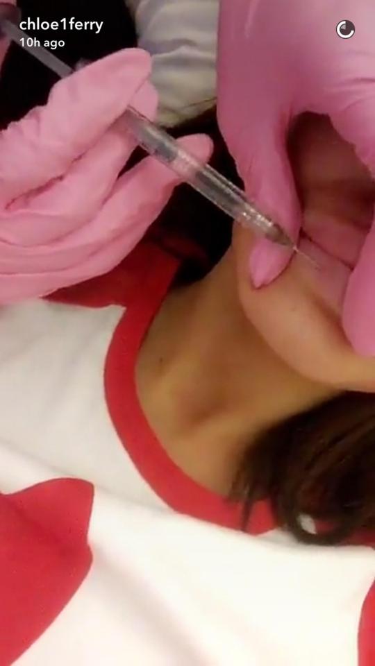  Earlier this week Chloe shared a video on Snapchat while getting her regular dose of lip filler which costs an average of £250 a pop