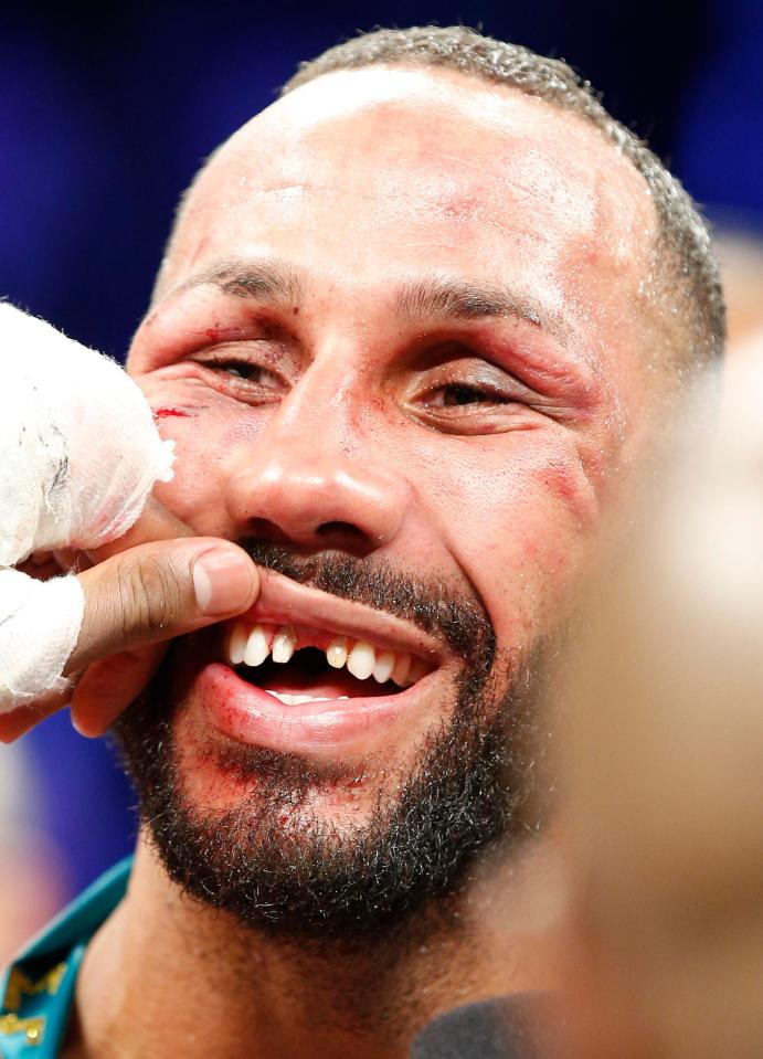  DeGale says he lost his front tooth in a sparring session before fight and Jack knocked out a temporary replacement