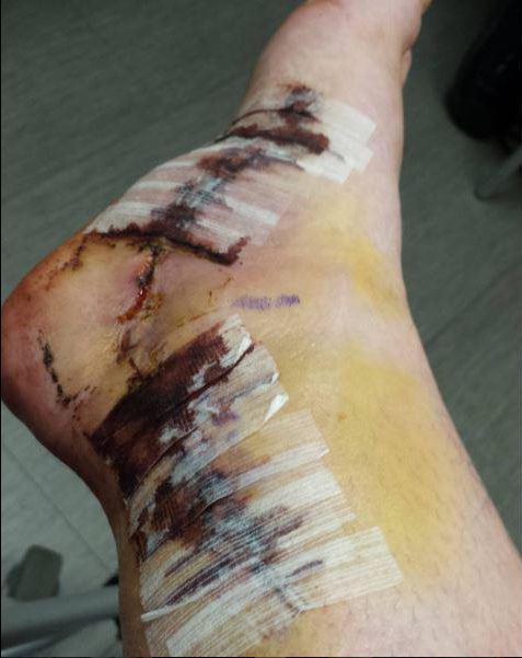 Kristi posted this snap of her cancerous foot before the operation to cut it off 