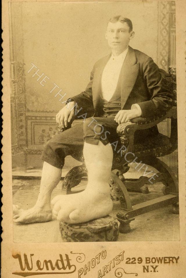  Eugene Berry, a young man with elephantiasis or Milroy's disease, circa 1890