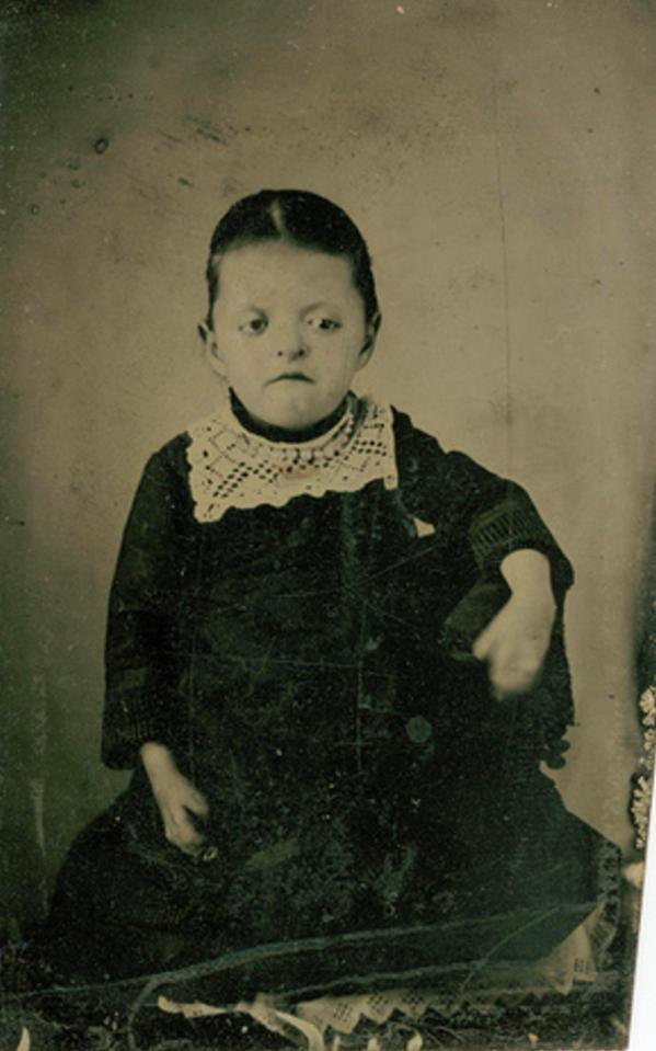  Little girl with Apert syndrome, circa 1870s. The disease was not recognised until decades after the image was taken