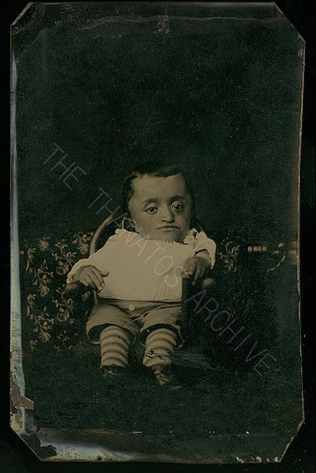  A child with a form of dwarfism pictured in the 1870s