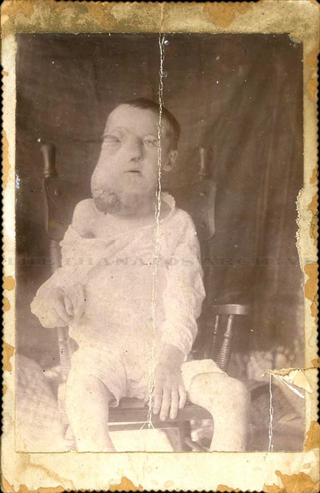  A boy with is pictured in 1890 and may have been suffering from Burkitt's Lymphoma