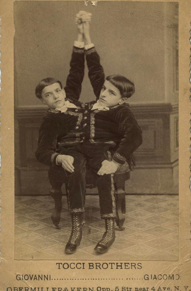  The Tocci Brothers, were Italian born conjoined twins born around 1875, they lived until 1912