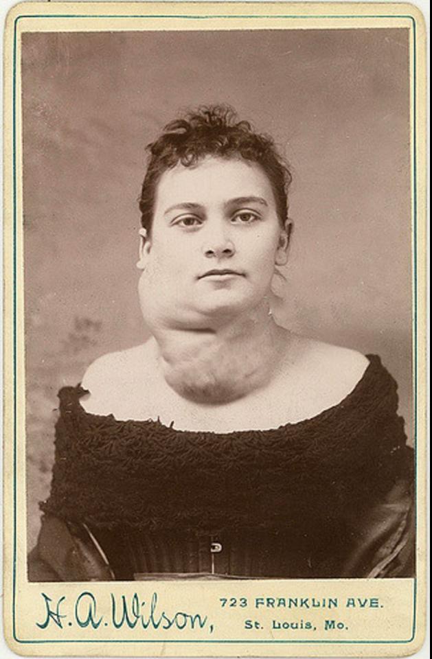  Young girl with a goiter or tumour circa 1890