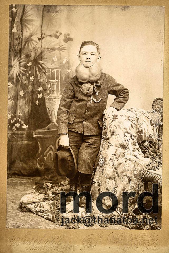  A boy with the rare condition Hyperthyroidism, which makes the neck swell, circa 1895