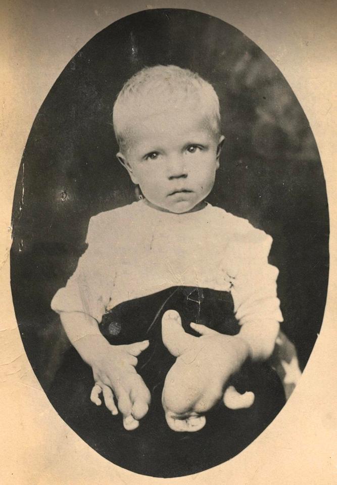  A photo postcard, circa 1915 of an angelic little boy with macrodactyly or local gigantism.