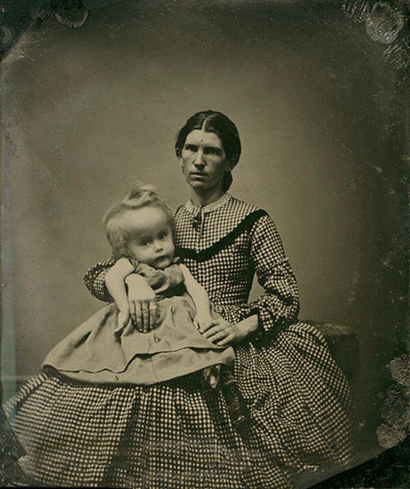  A hydrocephalic child with her mother in around 1862