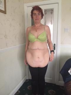  Nicola said: “The weight fell off at such a rate my body could not keep up and that meant my skin elasticity couldn’t keep up. The skin didn’t shrink, it hung off me and still does.”