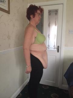  Following her gastric bypass surgery Nicola has been left with swathes of loose skin