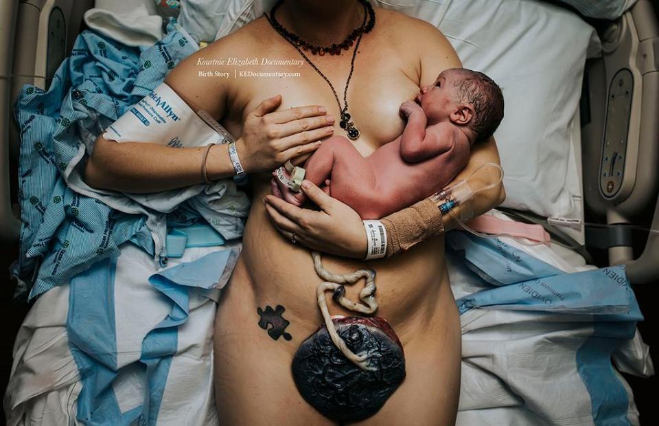  A mother breastfeeds her newborn baby while the umbilical cord is still attached