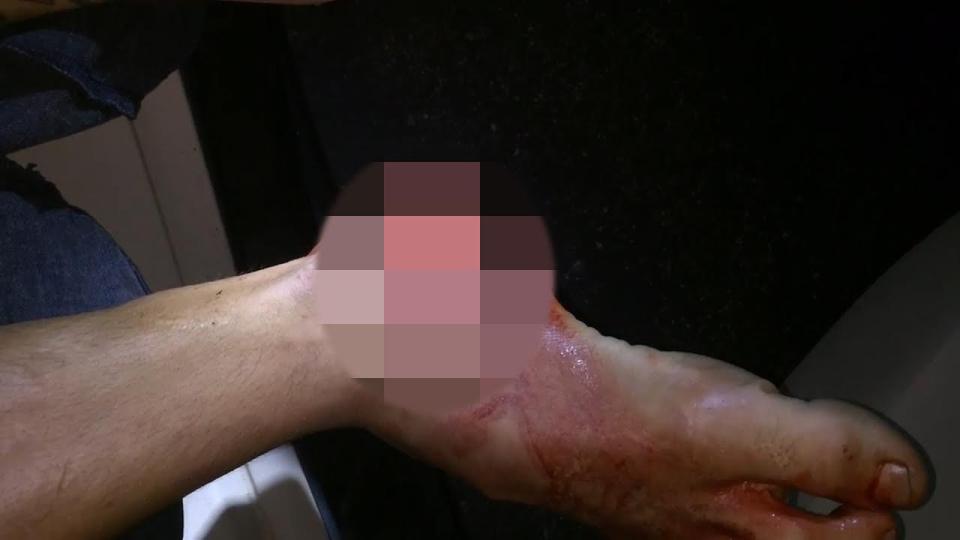  This nasty looking cut to his foot was the result of the mistimed jump into the pool