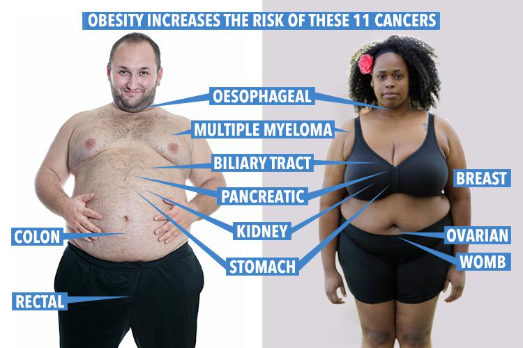  Being obese has been linked to 11 types of cancer, researchers at Imperial College London found