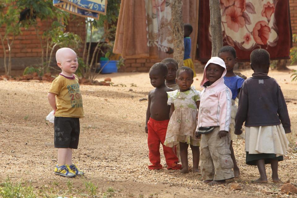  Albinism is a genetic disorder that affects one in 17,000 people who have problems producing melanin