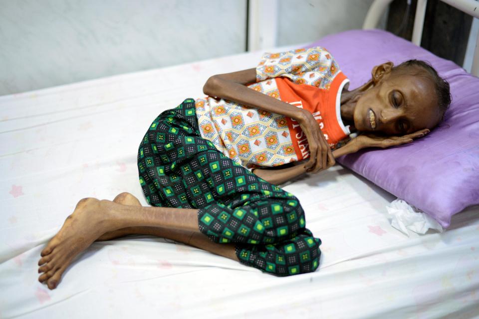  Saida Ahmad Baghili, 18, lies on a bed at the al-Thawra hospital where she receives treatment for severe acute malnutrition